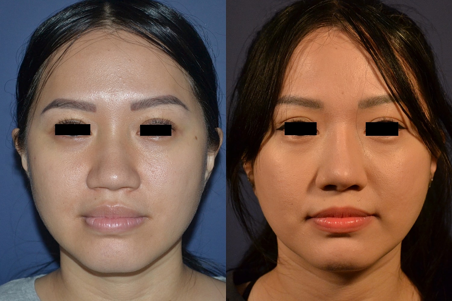 Before and after facial treatment comparison image.