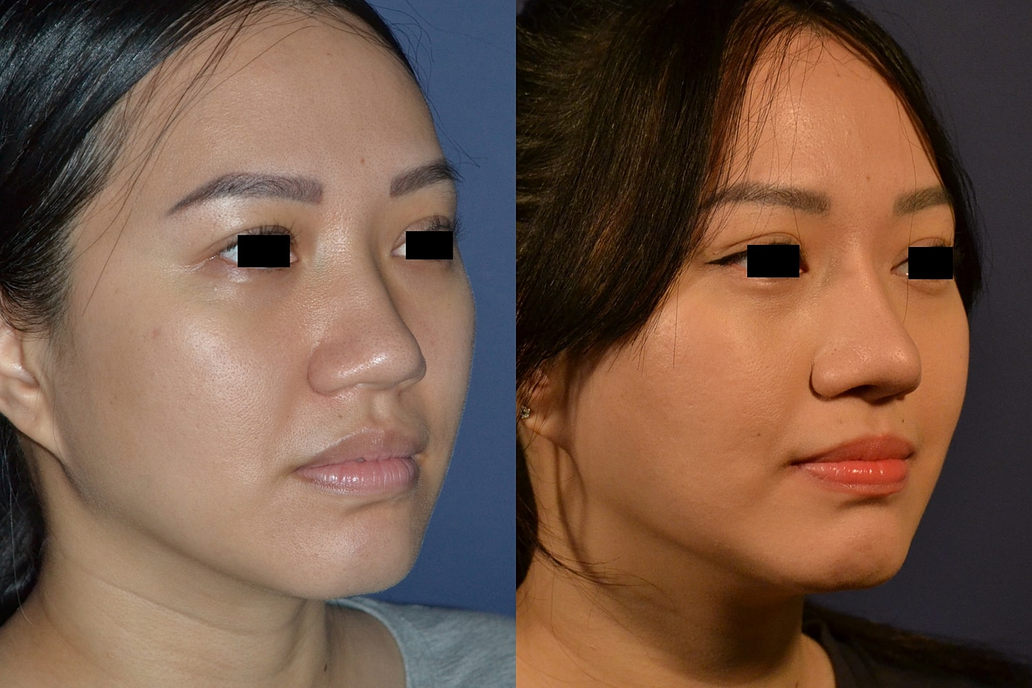 Before and after photo of a facial enhancement.