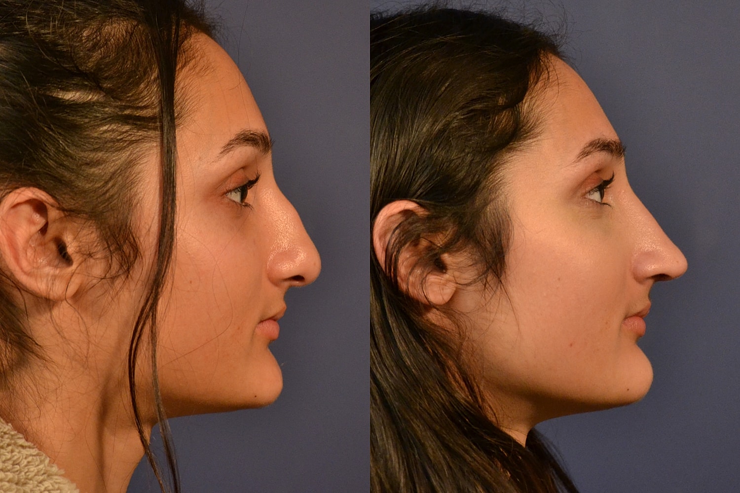 Ethnic Rhinoplasty  Before & After