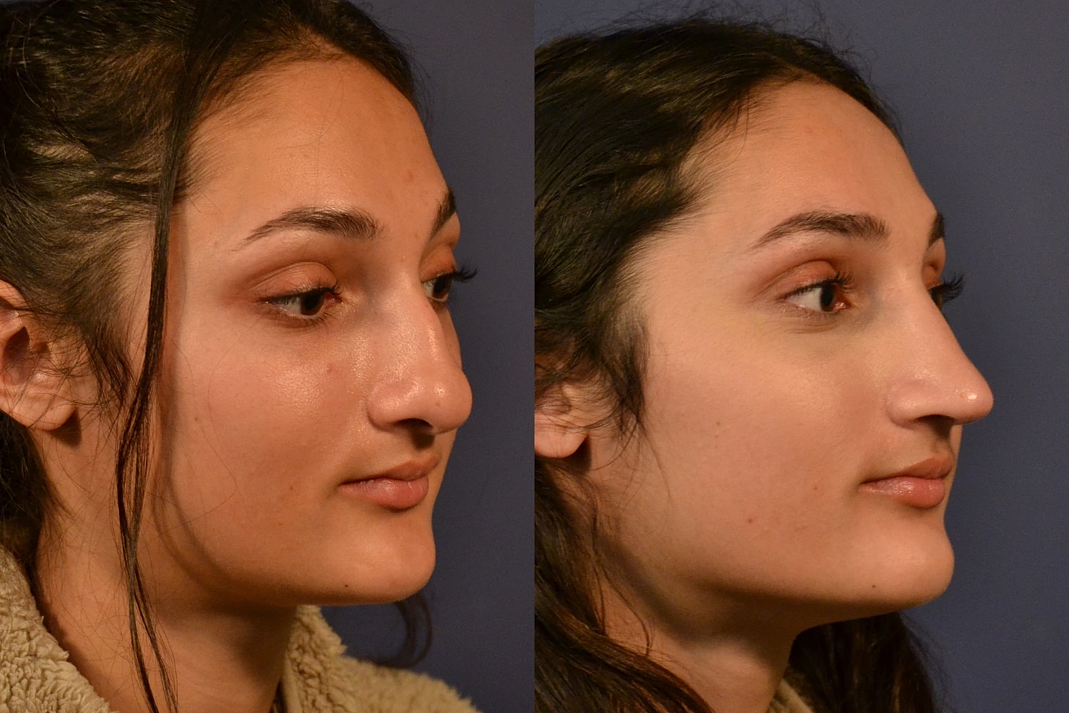 Ethnic Rhinoplasty  Before & After