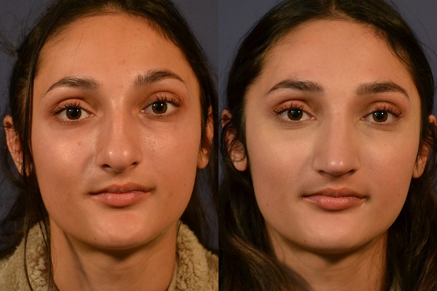 Ethnic Rhinoplasty  Before & After