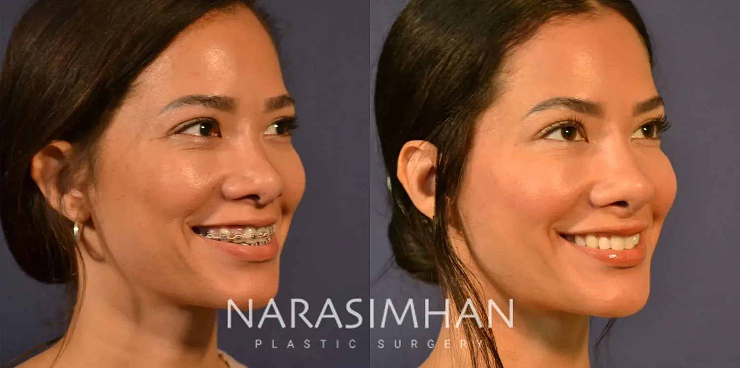 Ethnic Rhinoplasty  Before & After
