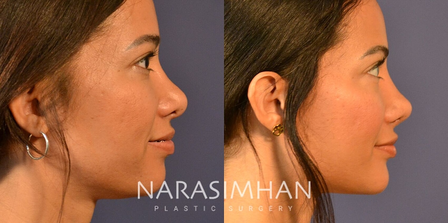 Ethnic Rhinoplasty  Before & After