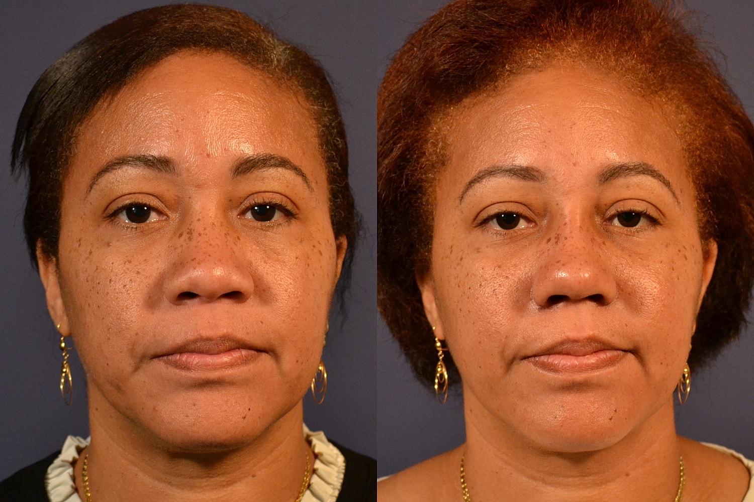 Ethnic Rhinoplasty  Before & After