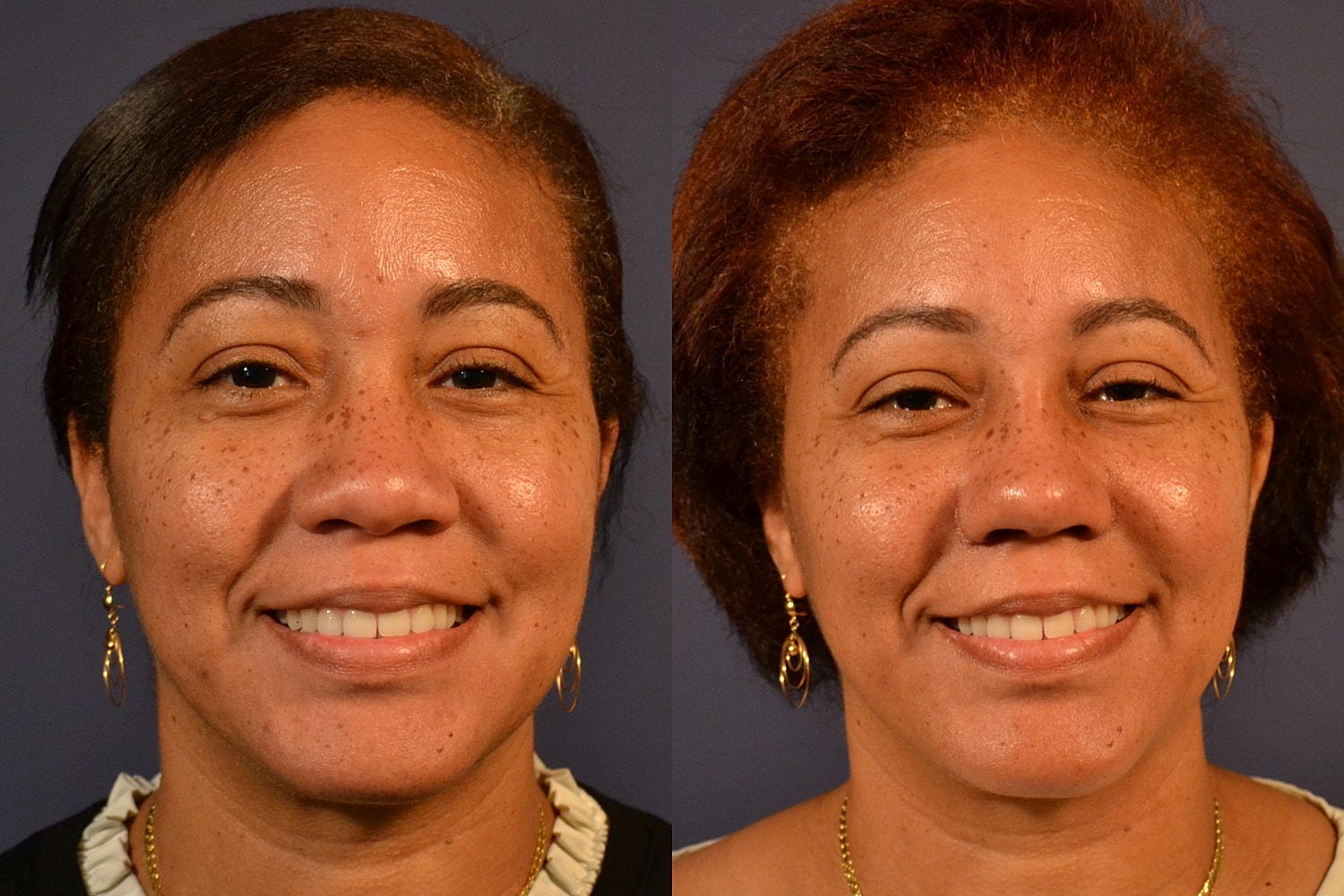 Ethnic Rhinoplasty  Before & After