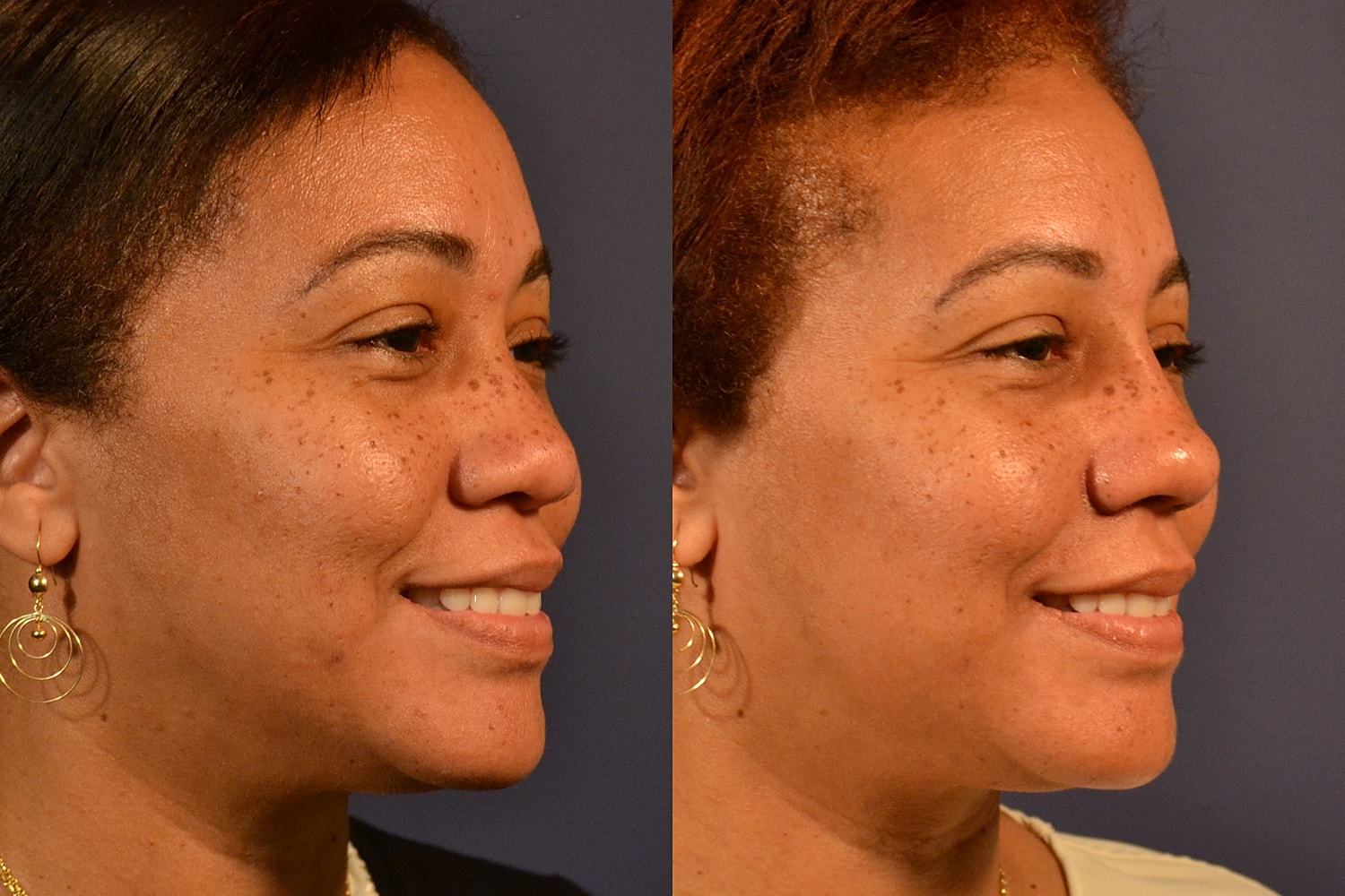 Ethnic Rhinoplasty  Before & After
