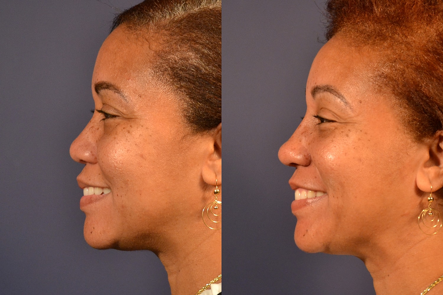 Ethnic Rhinoplasty  Before & After