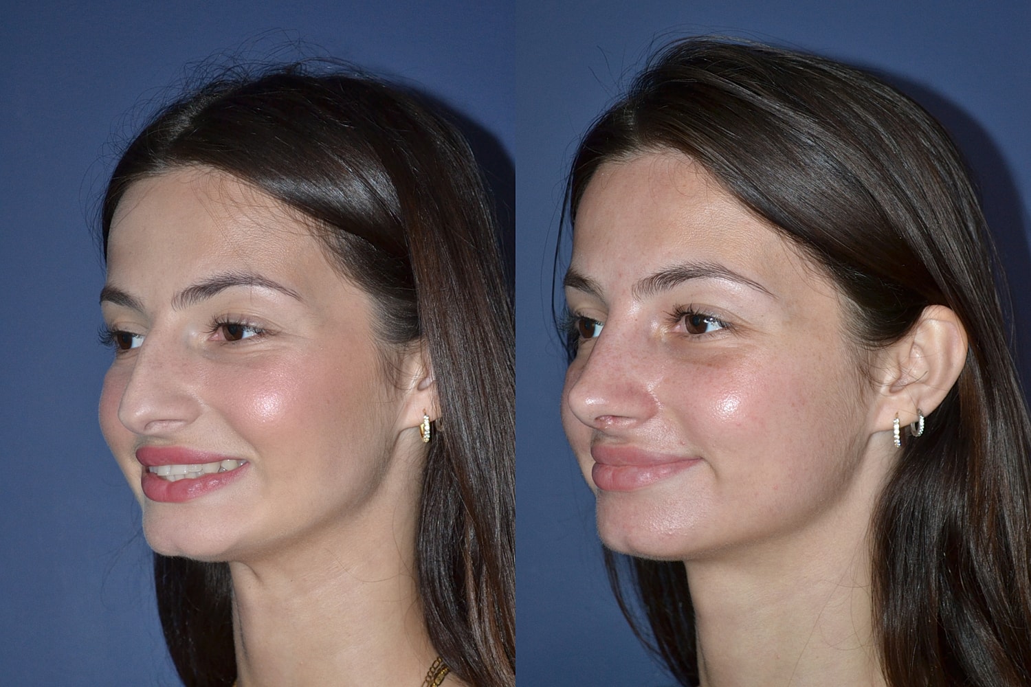 Ethnic Rhinoplasty  Before & After