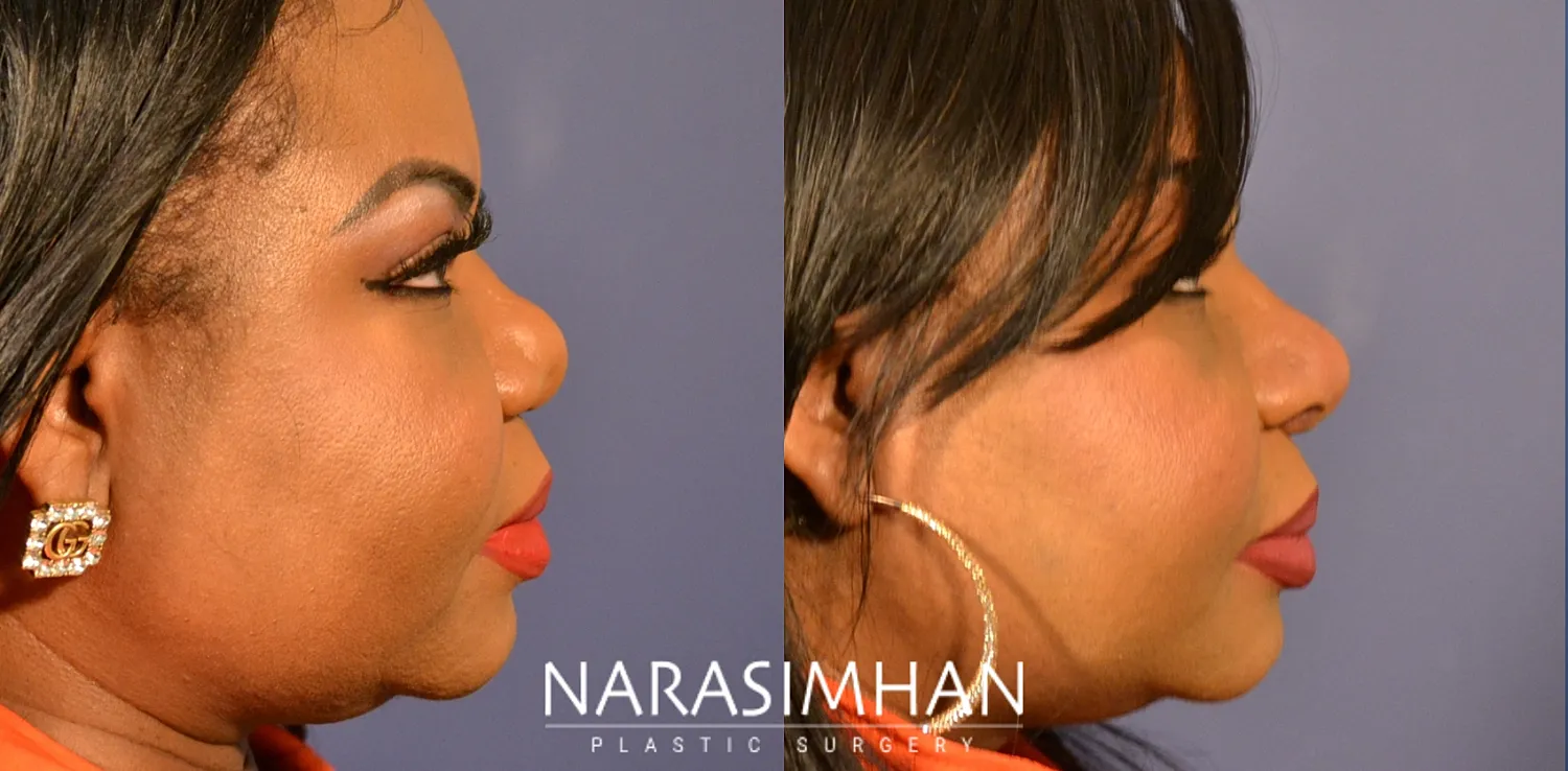 Ethnic Rhinoplasty  Before & After