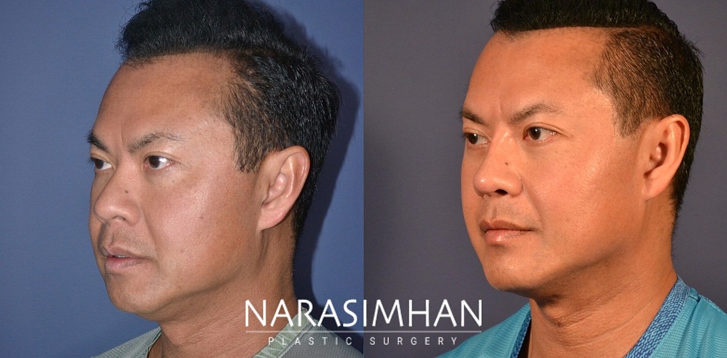 Ethnic Rhinoplasty  Before & After