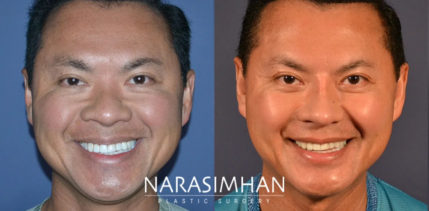 Ethnic Rhinoplasty  Before & After