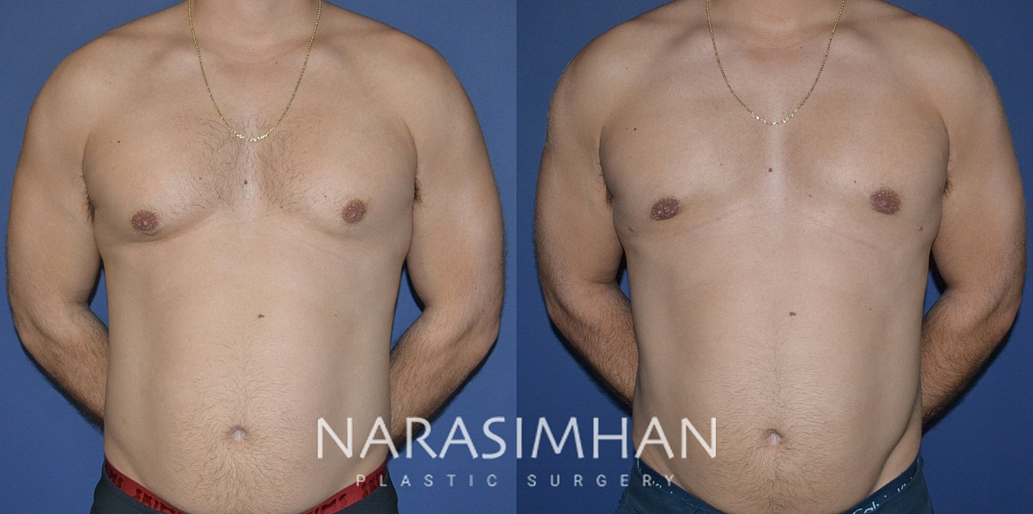 Body Contouring Before & After