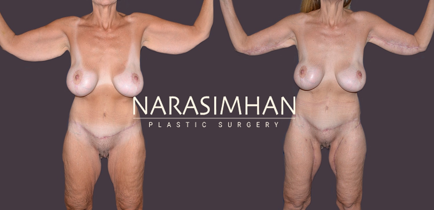 Body Contouring Before & After