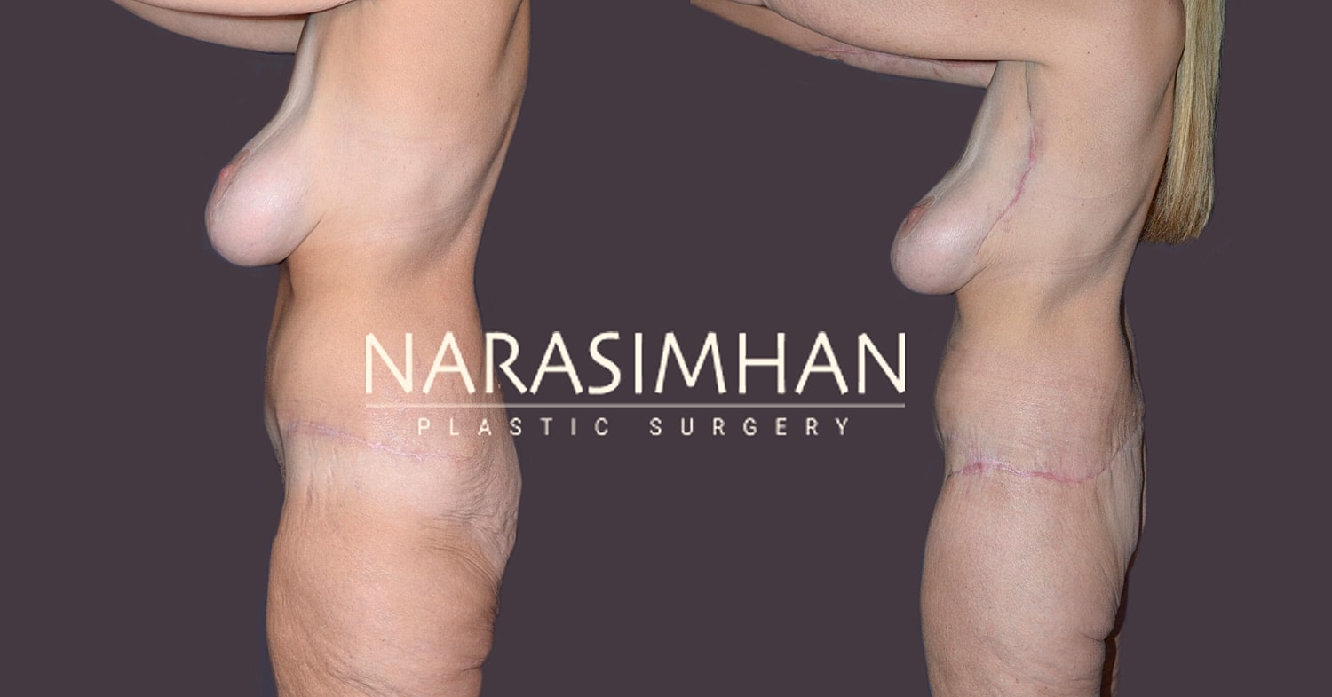 Body Contouring Before & After