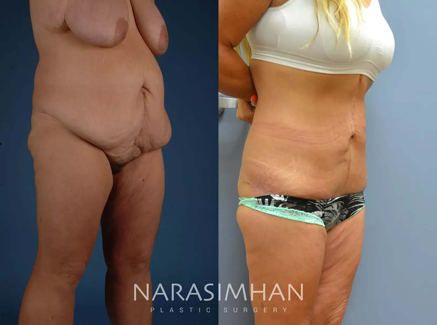Body Contouring Before & After