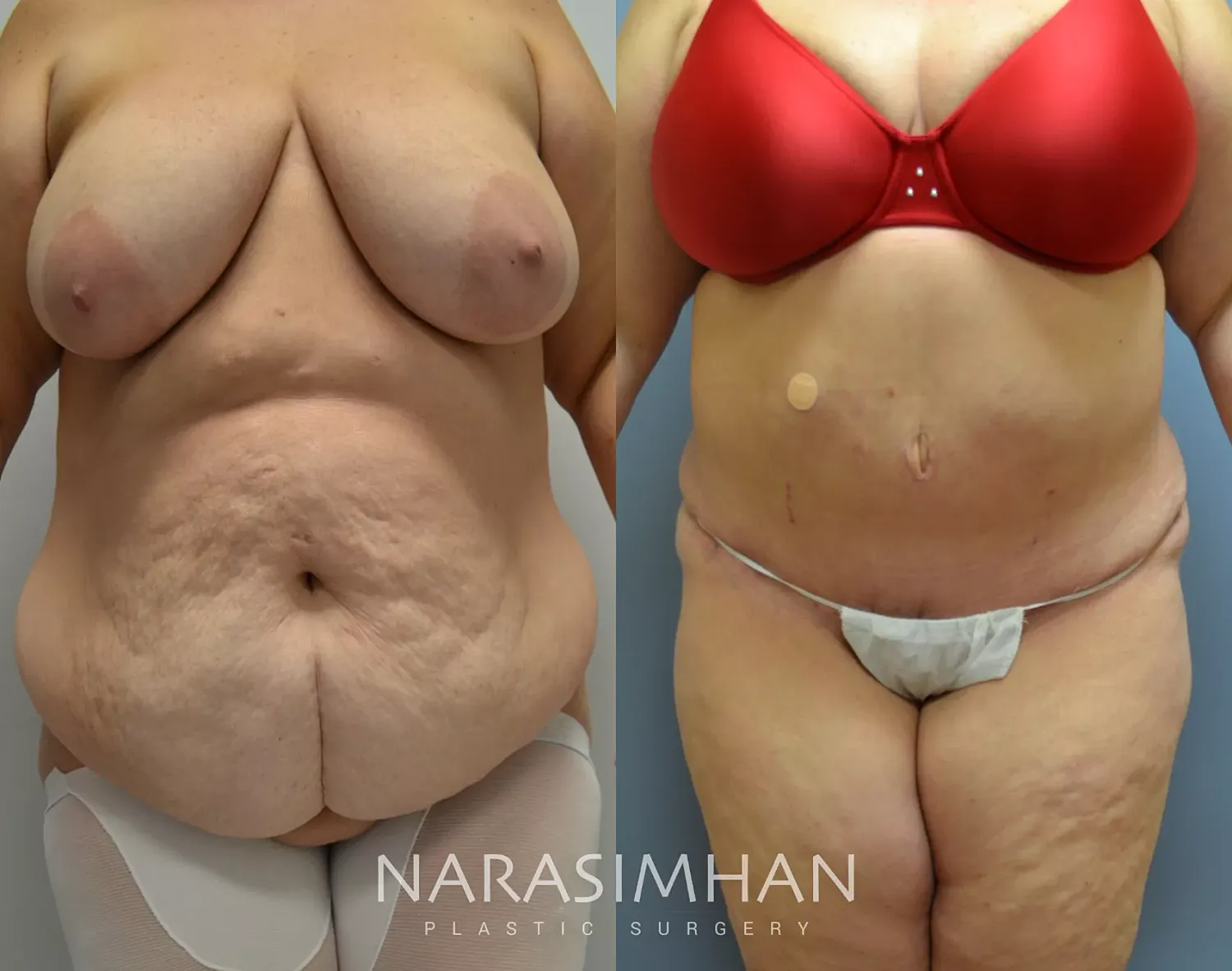 Body Contouring Before & After