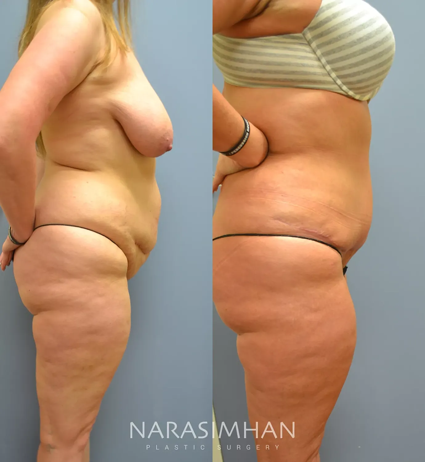 Body Contouring Before & After