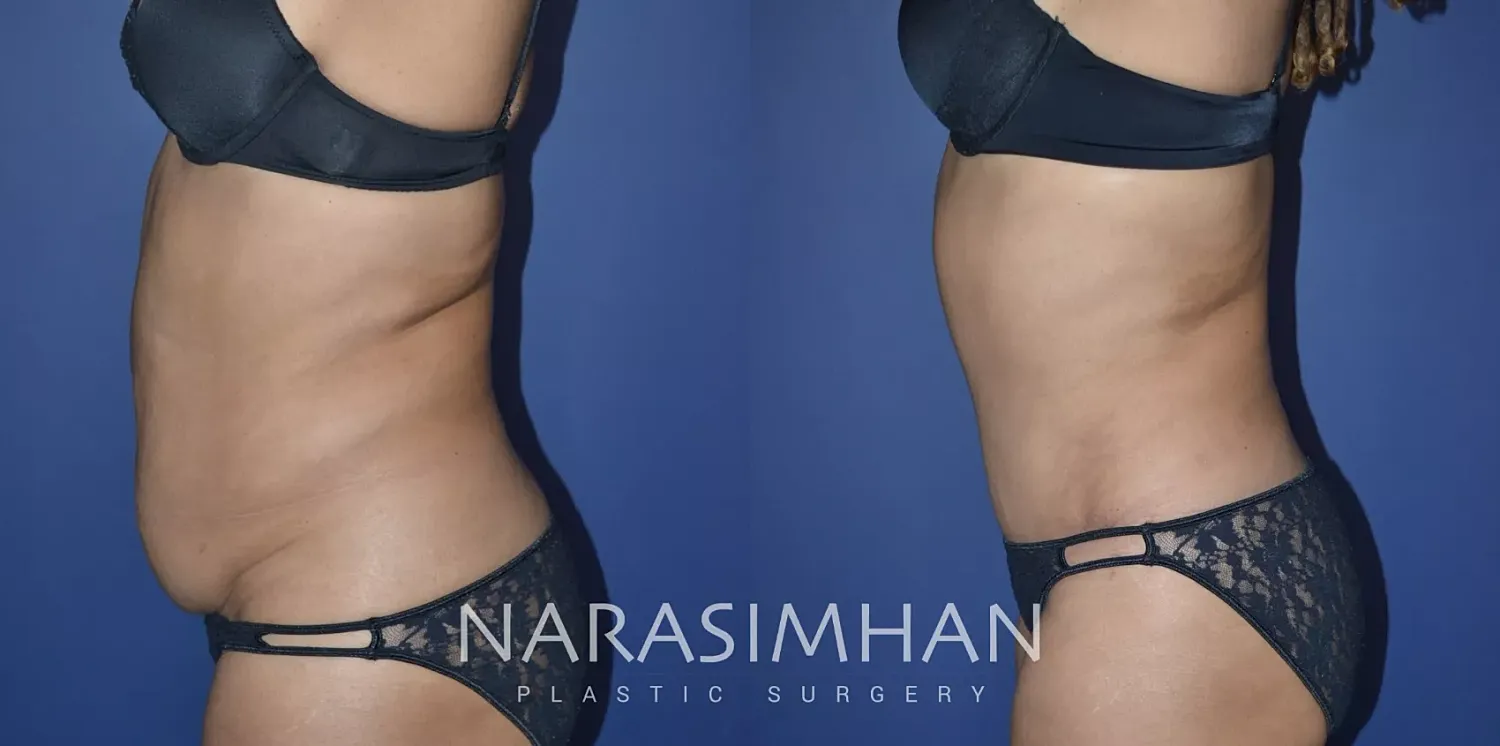 Body Contouring Before & After