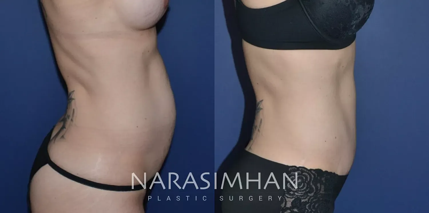 Body Contouring Before & After
