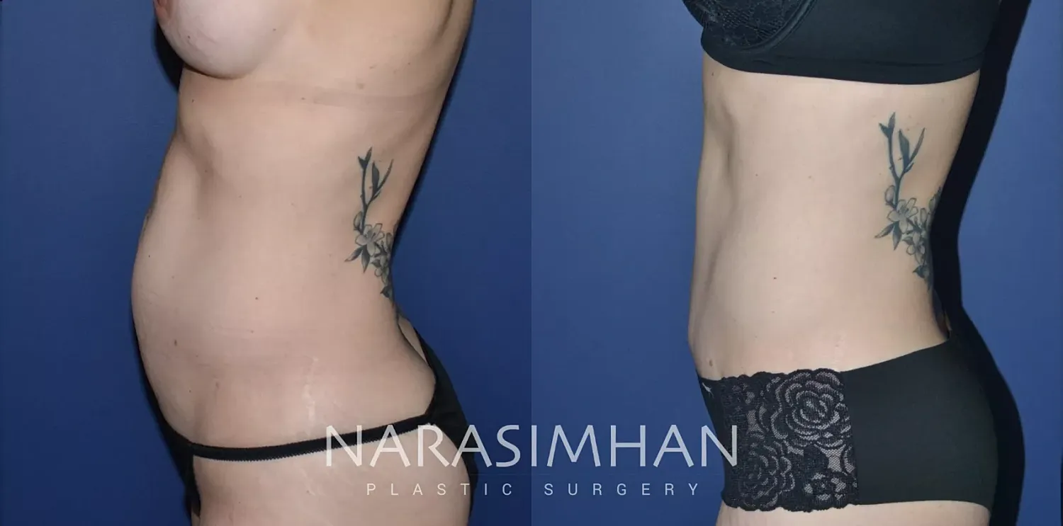 Body Contouring Before & After