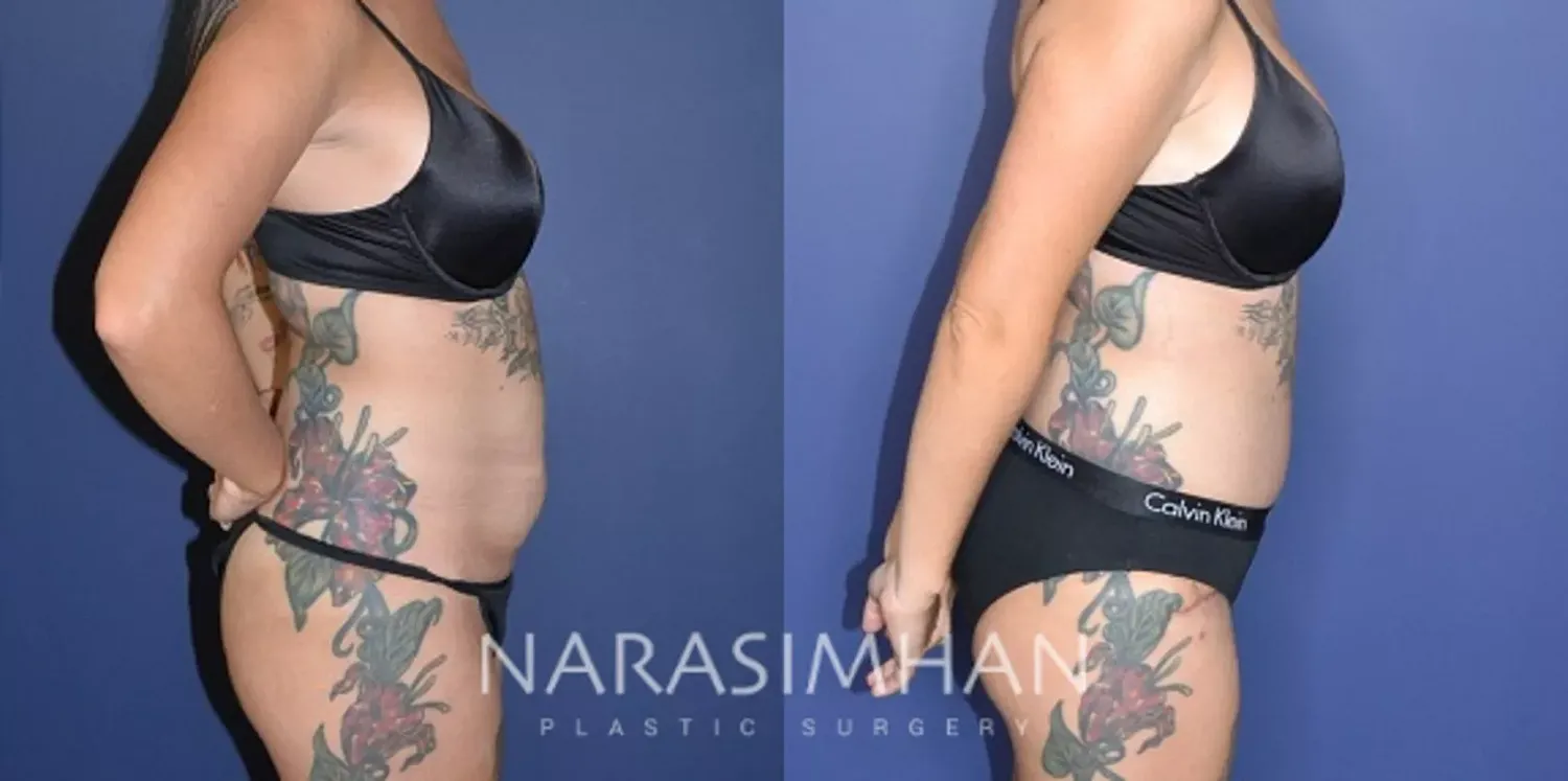 Body Contouring Before & After