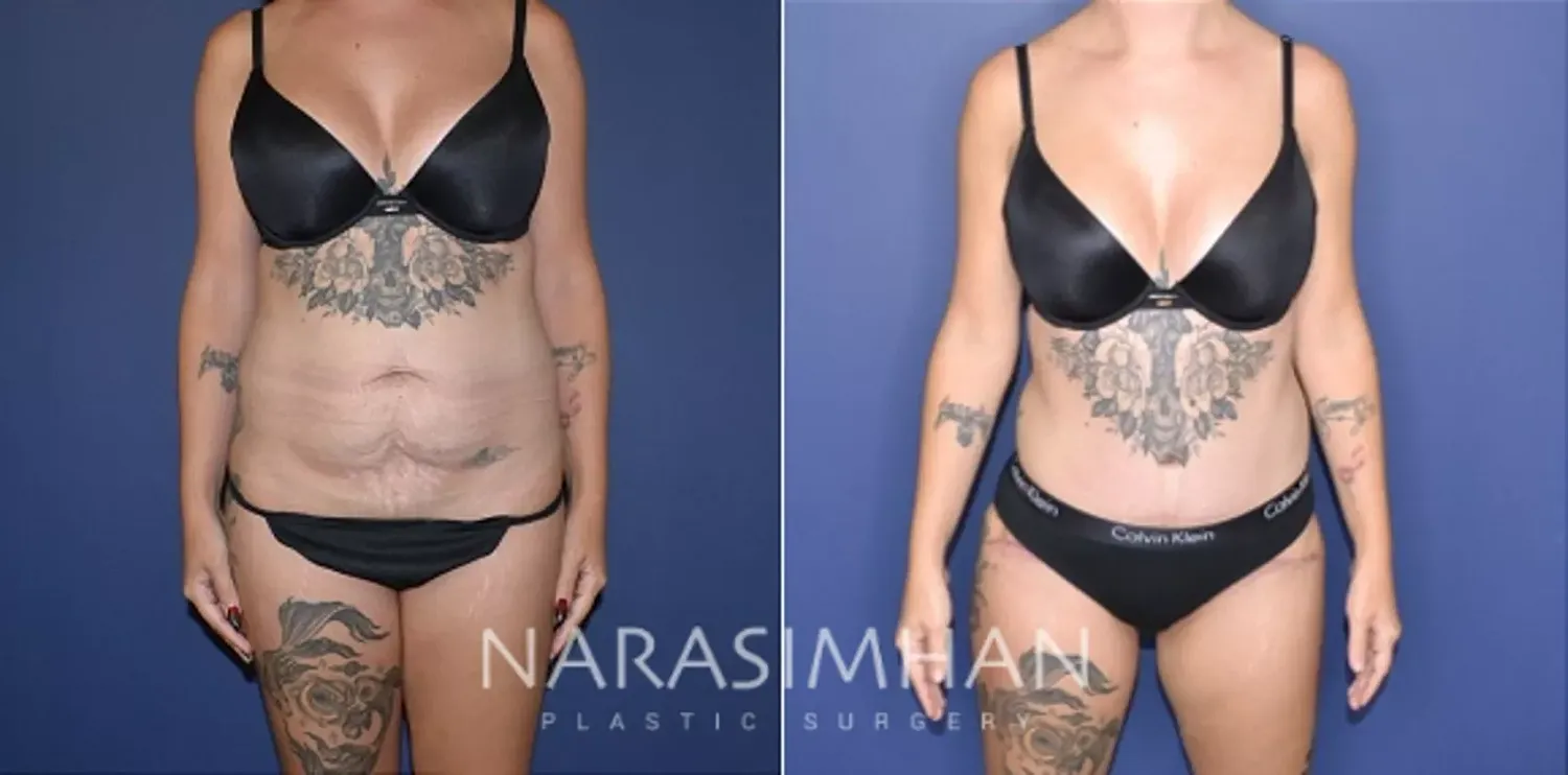 Body Contouring Before & After