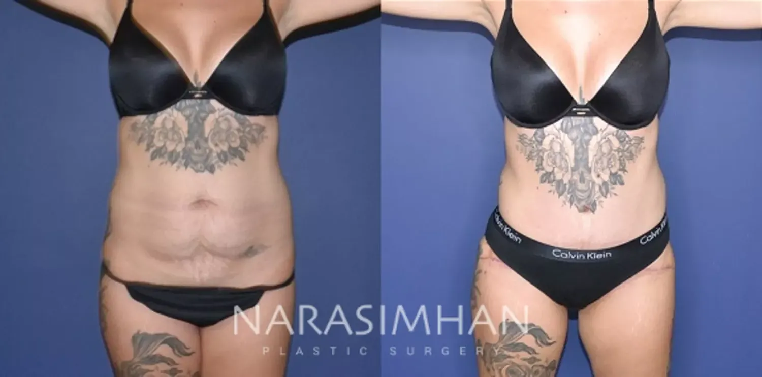 Body Contouring Before & After