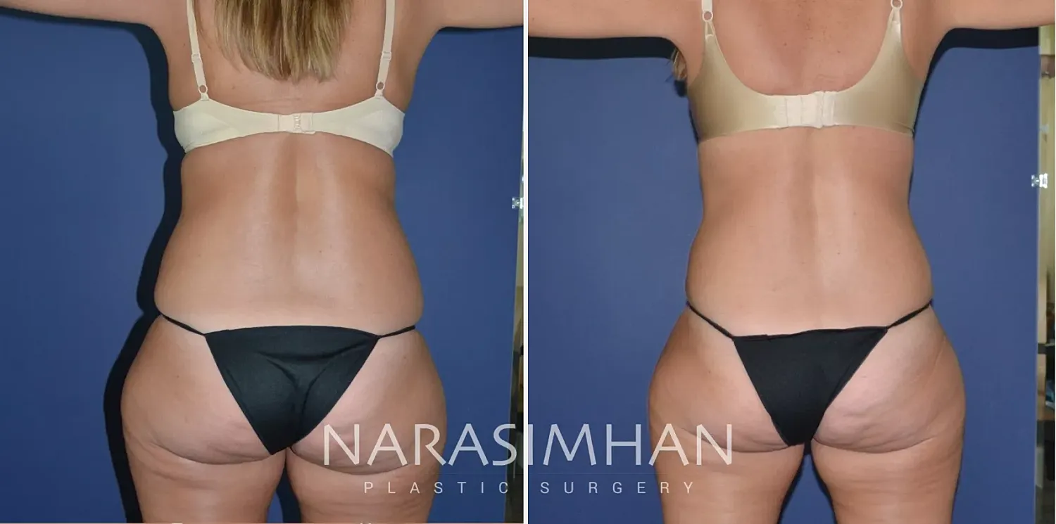 Body Contouring Before & After
