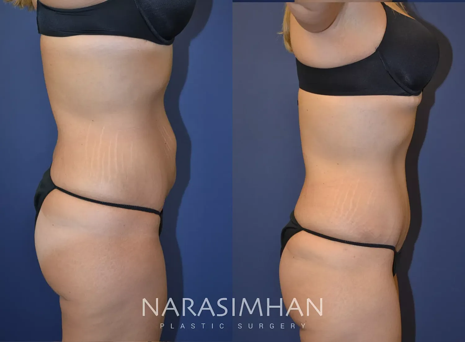 Body Contouring Before & After
