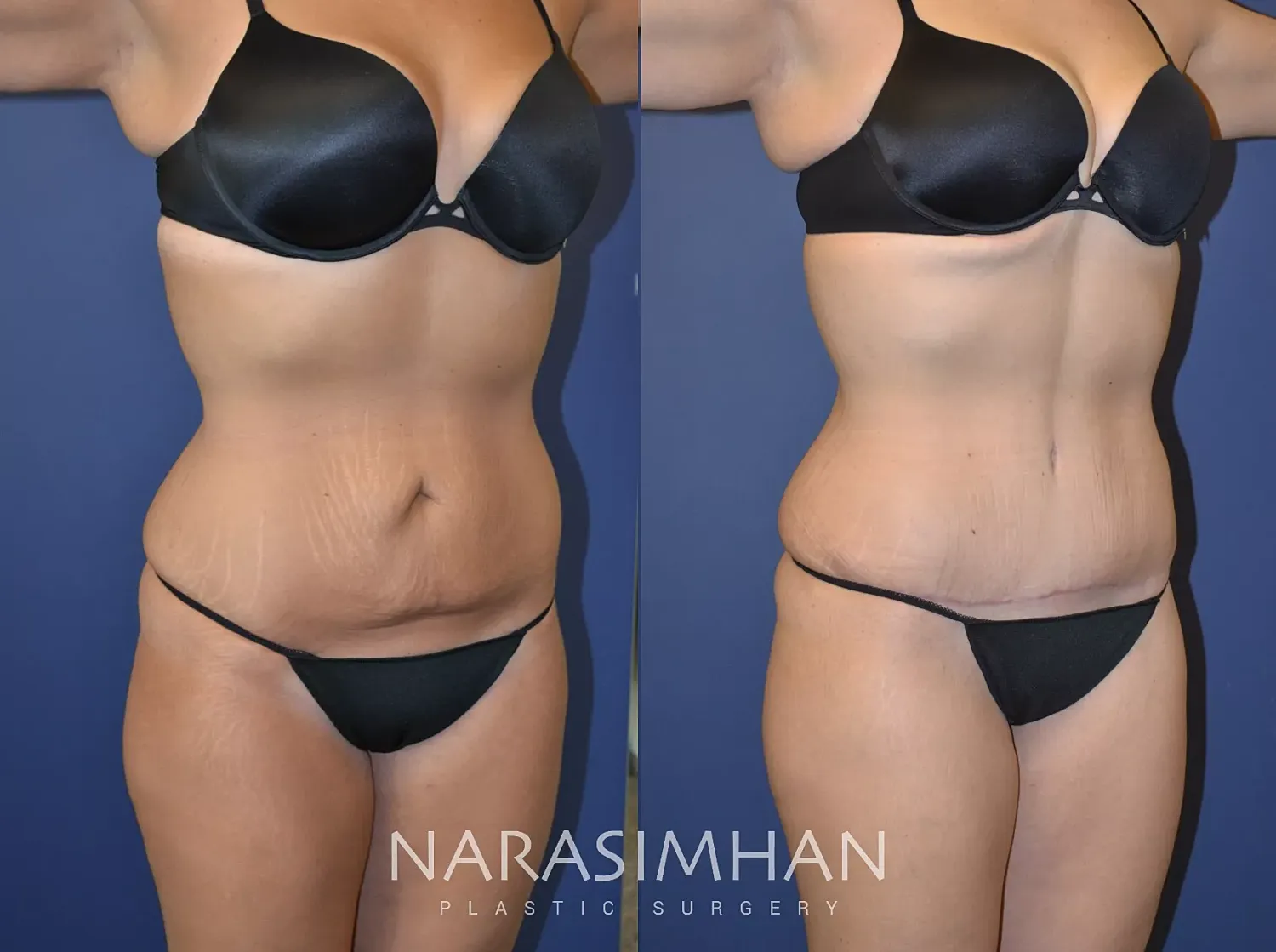 Body Contouring Before & After