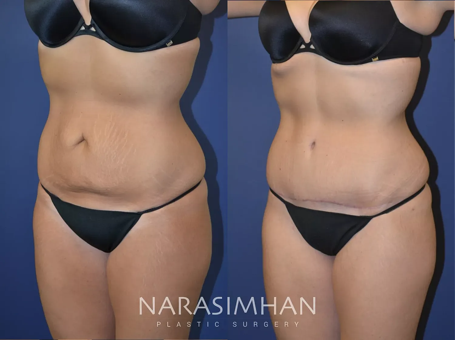 Body Contouring Before & After