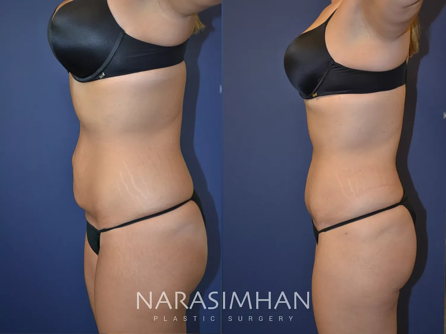 Body Contouring Before & After