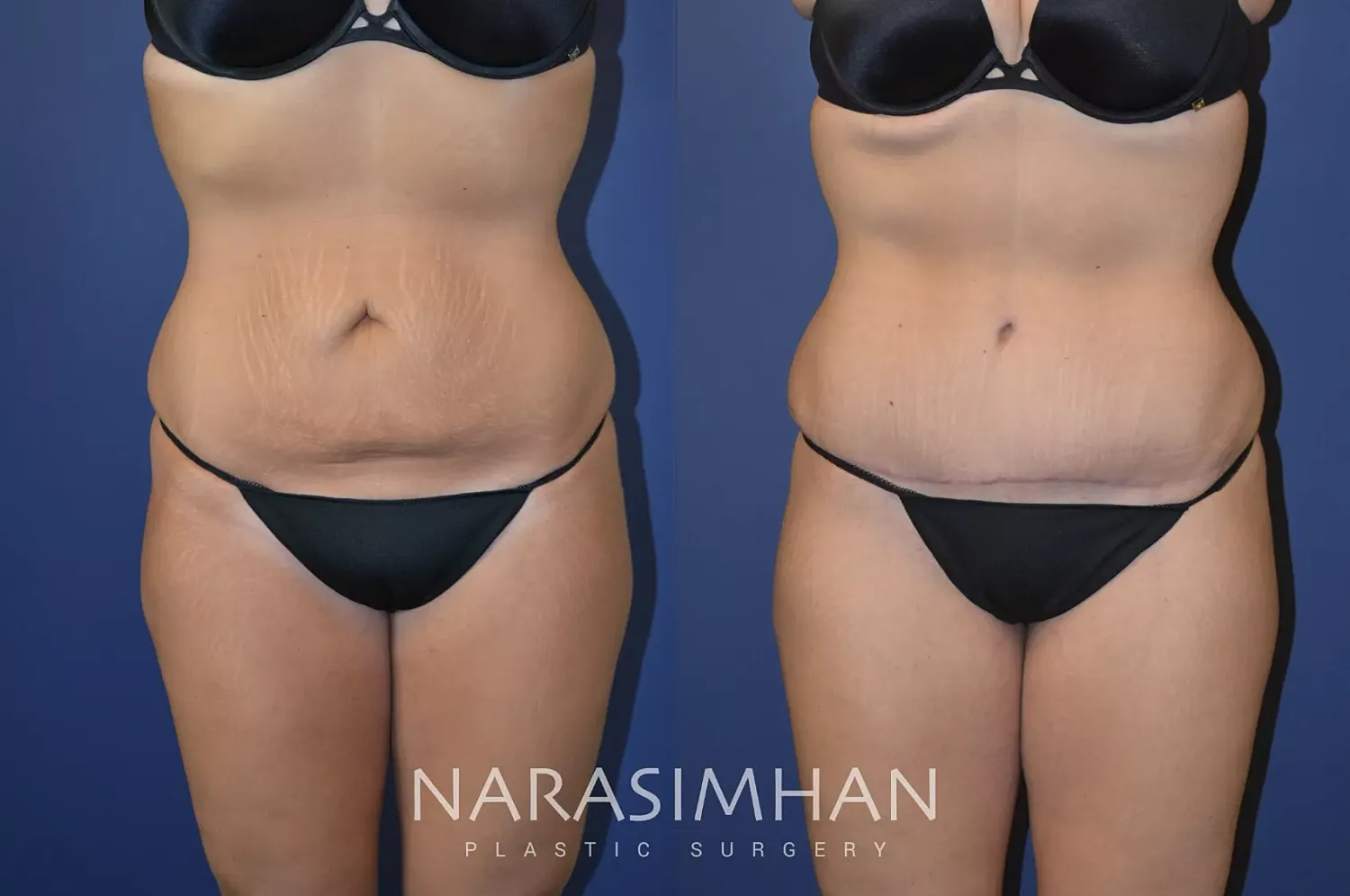 Body Contouring Before & After