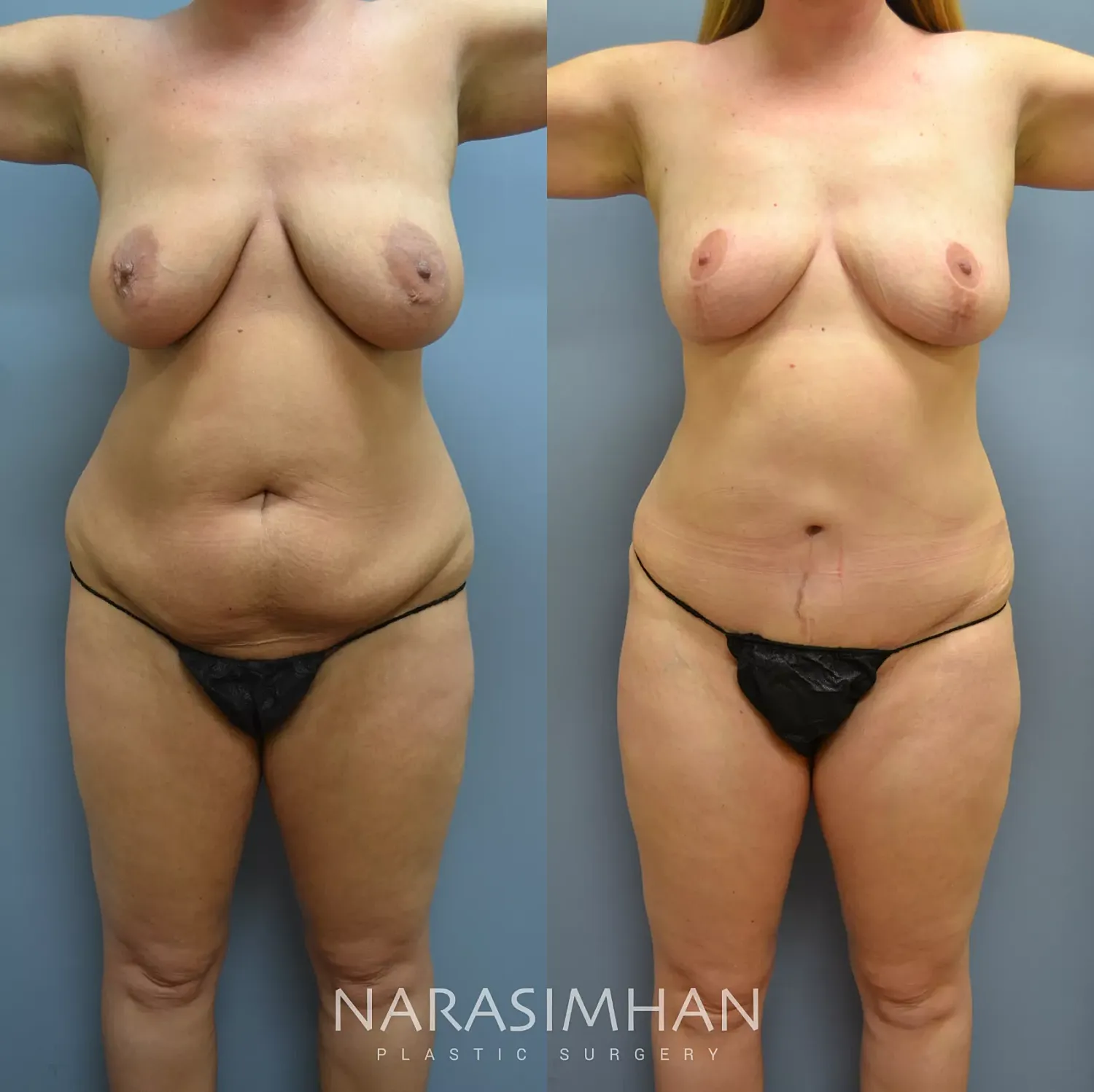 Body Contouring Before & After