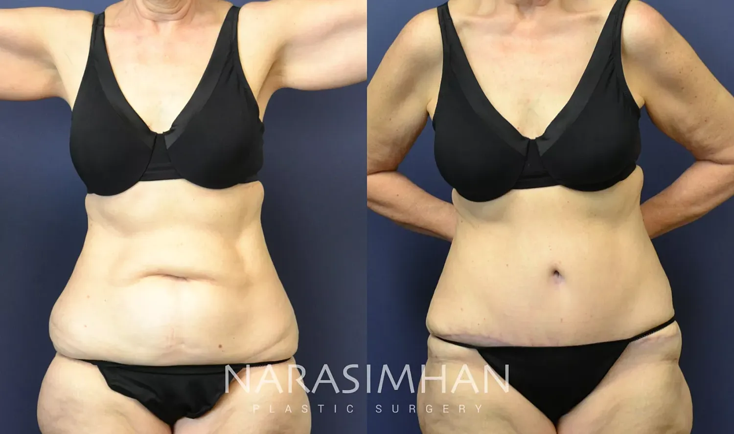 Body Contouring Before & After