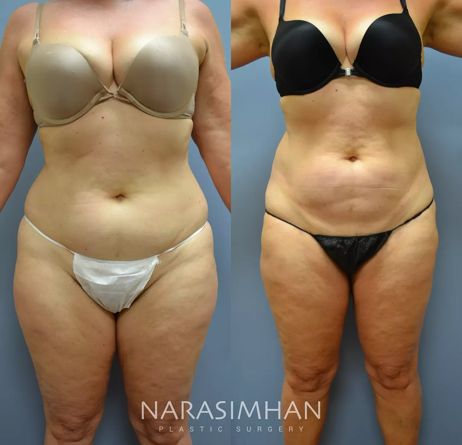 Body Contouring Before & After