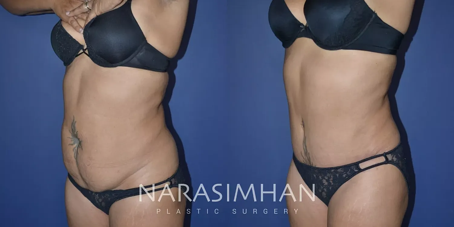 Body Contouring Before & After