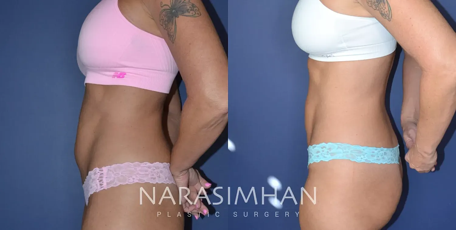 Body Contouring Before & After