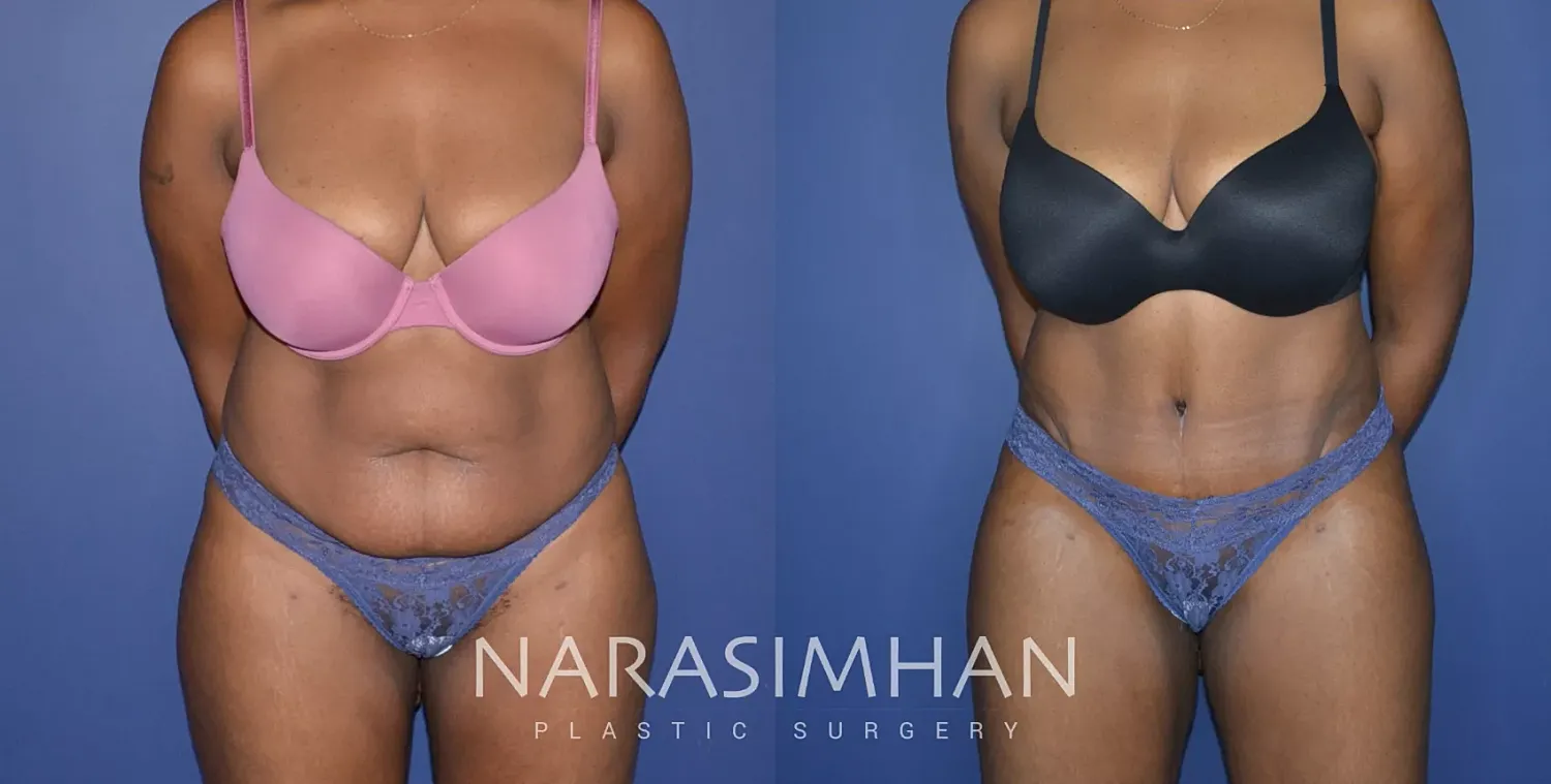Body Contouring Before & After