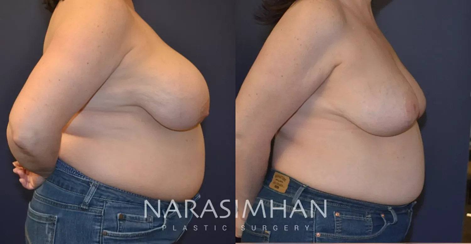 Body Contouring Before & After