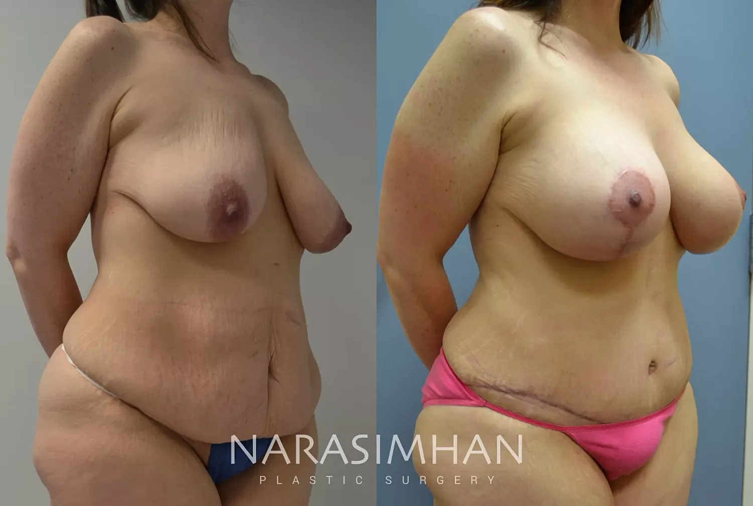 Body Contouring Before & After