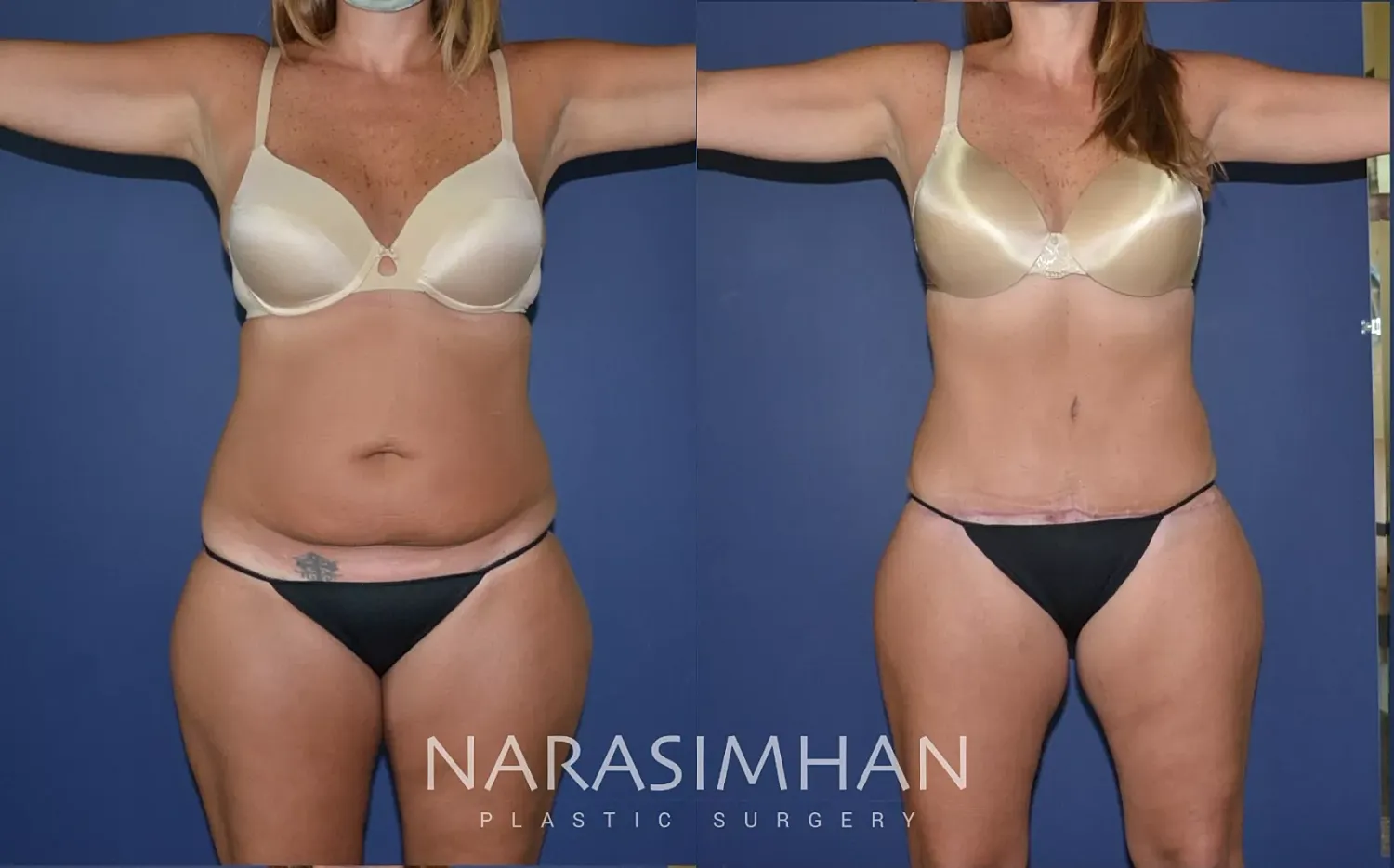 Body Contouring Before & After
