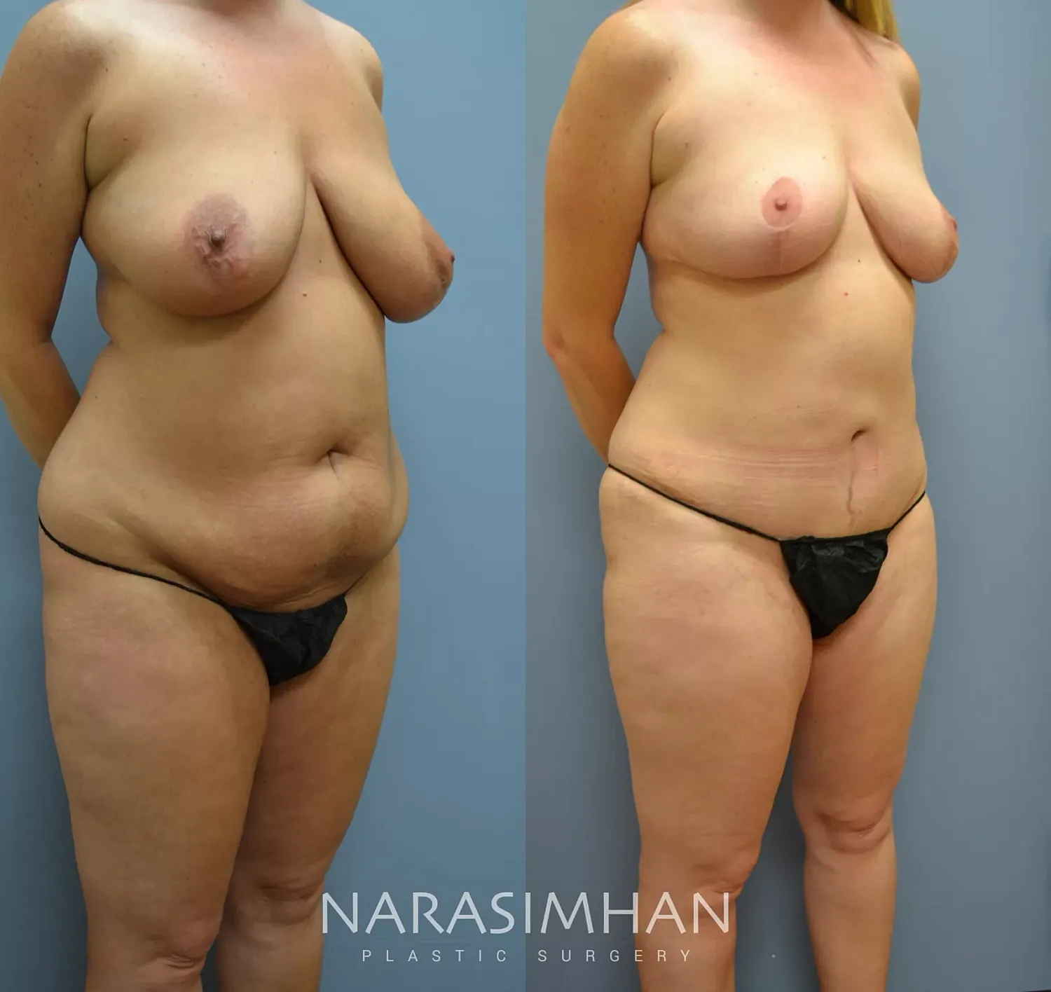Body Contouring Before & After