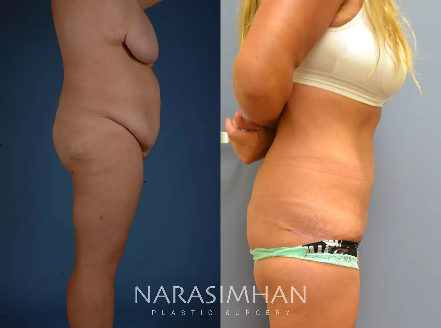 Body Contouring Before & After