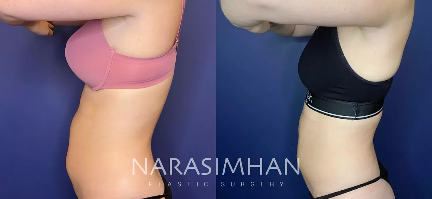 Body Contouring Before & After