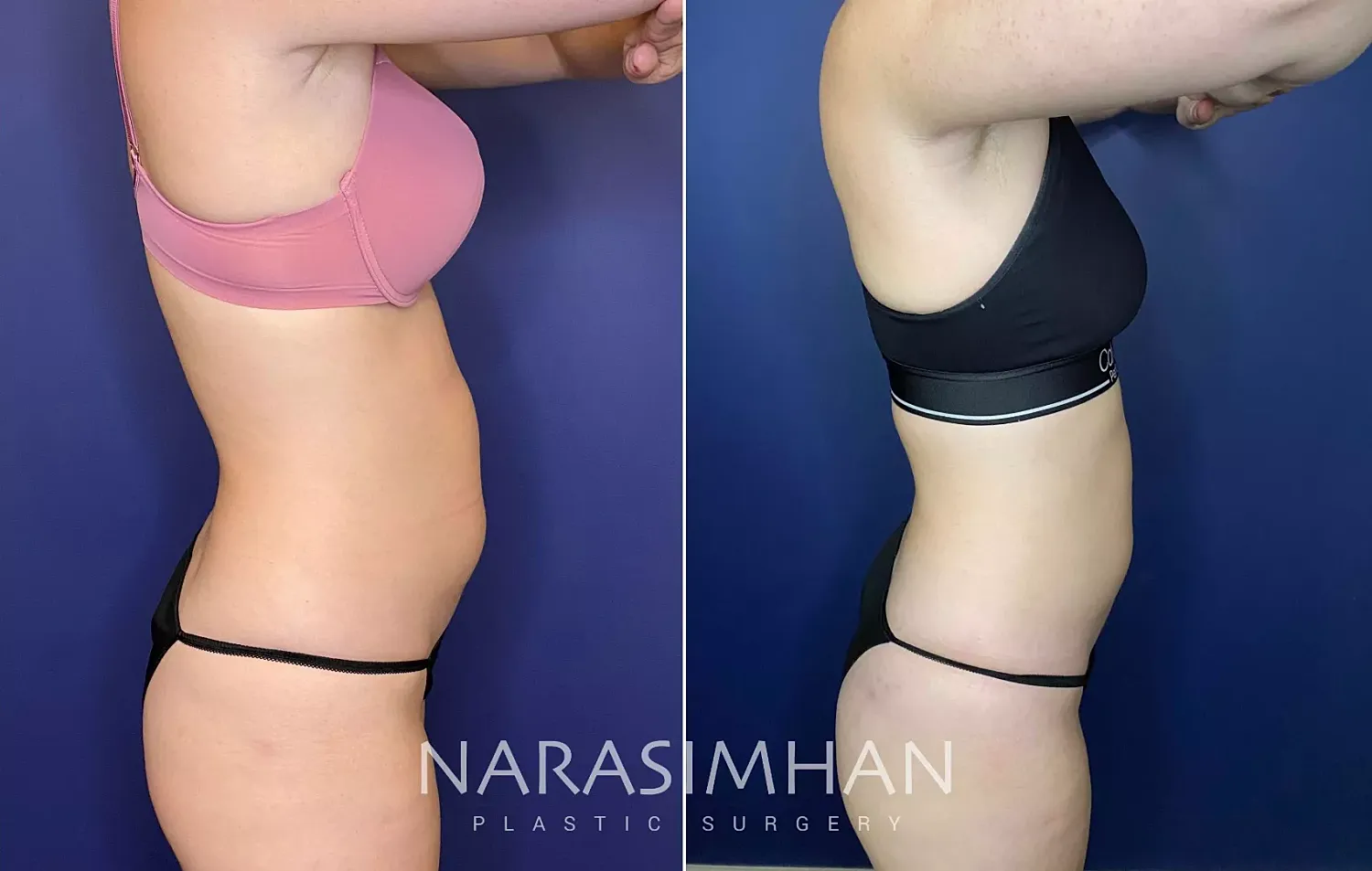 Body Contouring Before & After