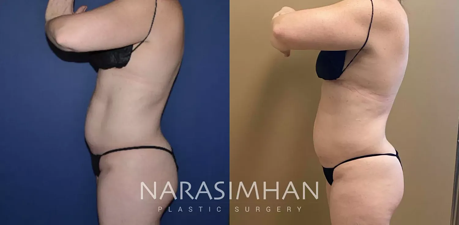 Body Contouring Before & After