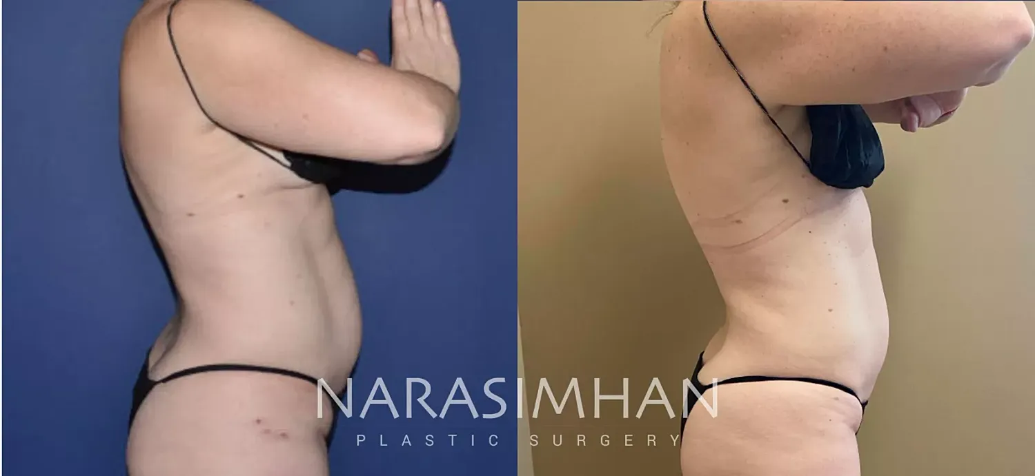 Body Contouring Before & After