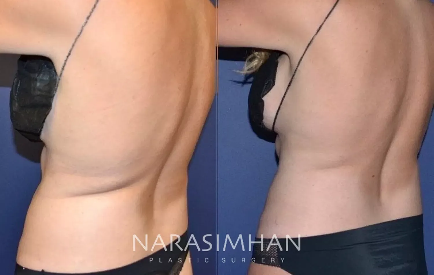 Body Contouring Before & After