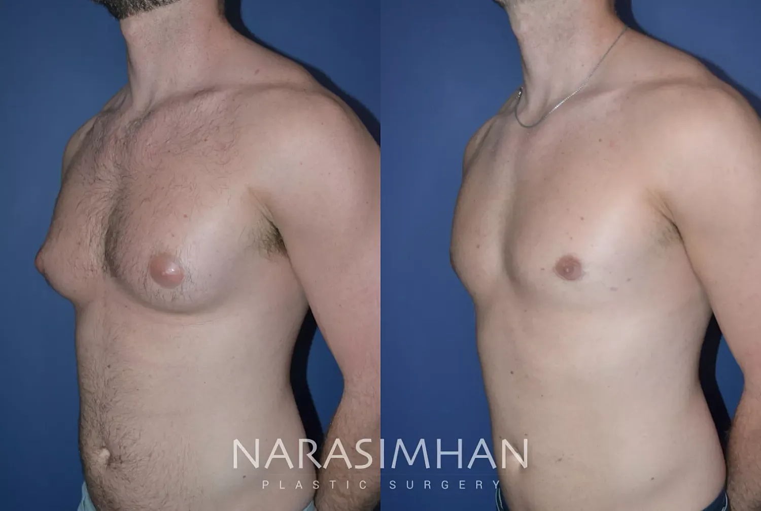 Body Contouring Before & After